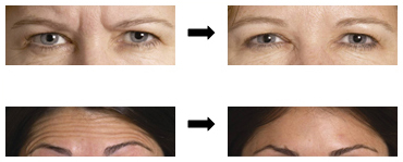 Wrinkle Relaxing Injection | Hamilton Dental Care